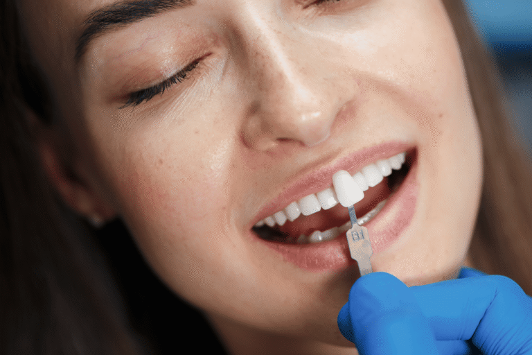 Cosmetic Veneers Dentistry. Ceramic & composite