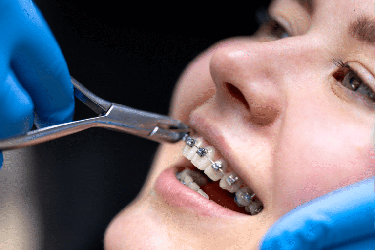 Orthodontics-Fixed-Wires